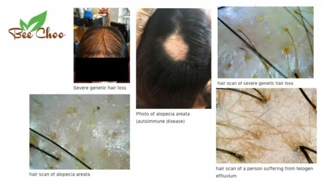 5 CAUSES OF HAIR LOSS AND WHERE TO FIND HAIR TREATMENT IN THAILAND