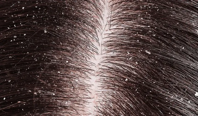WHY IS MY SCALP DRY? WAYS TO COMBAT DRY SCALP?