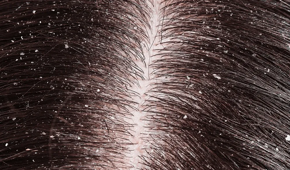 WHY IS MY SCALP DRY? WAYS TO COMBAT DRY SCALP?