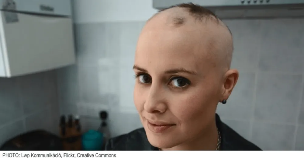 SUFFERING FROM ALOPECIA HAIR LOSS? LEARN MORE NATURAL HERBAL SCALP TREATMENT IN BANGKOK THAILAND