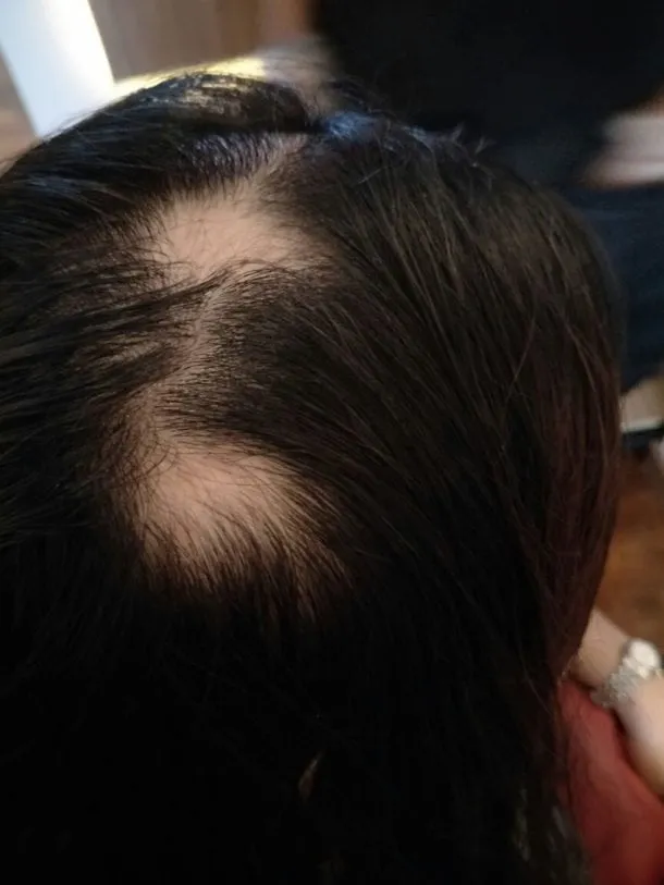Example of Alopecia Areata, i.e. Ghost Shave