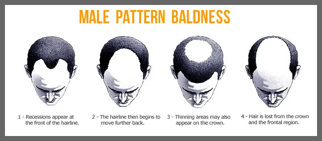 Source: https://orlandohairtransplant.org/male-pattern-baldness/