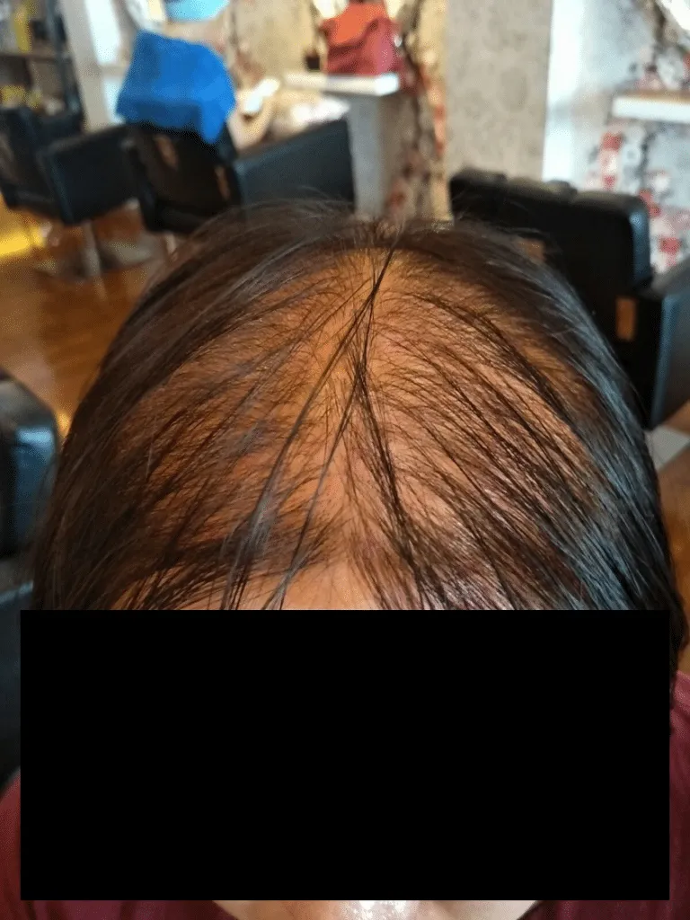 Severe genetic hair loss