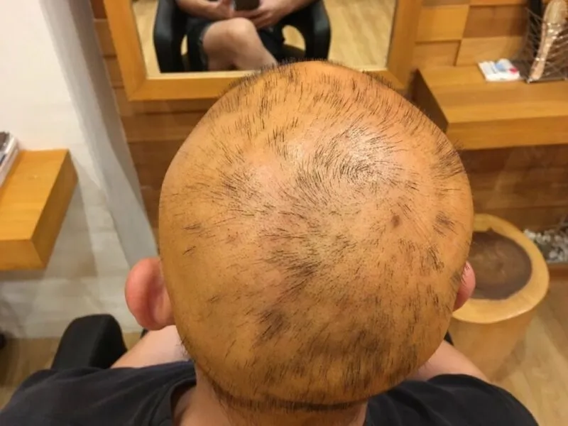 (Hair loss due to chemical dye, photo by Bee Choo, May 2017)