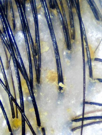 Dandruff called by oiliness – Photo credits Bee Choo Origin