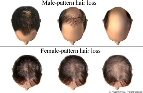 Source: https://www.healthlinkbc.ca/health-topics/hair-loss
