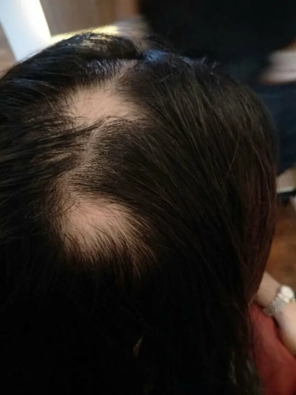 Customer suffering from Alopecia Areata taken on 2017-05-09 by Bee Choo Origin