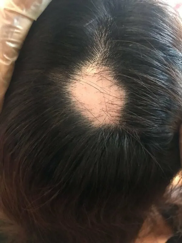 Photo of alopecia areata (autoimmune disease)