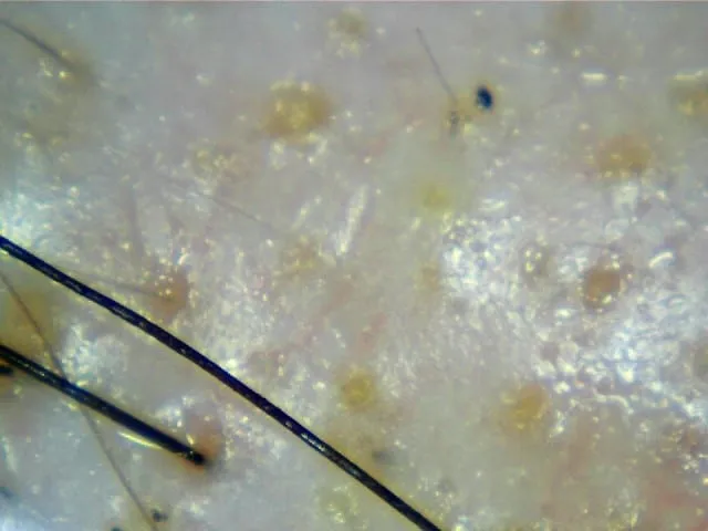 hair scan of alopecia areata