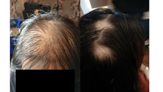Diffused hair loss vs patchy hair loss