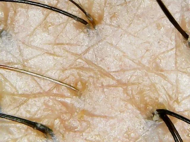 hair scan of a person suffering from telogen effluvium