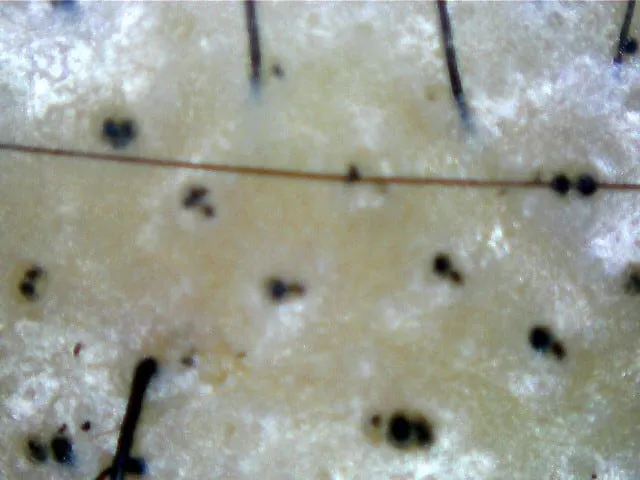Broken off hairs caused by tinea capitis, photo taken by Bee Choo Origin