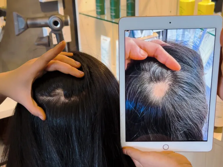 Bee Choo treatment for bacterial infection and alopecia areata