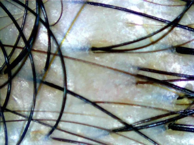Hair Scan After Bee Choo Hebral Treatment Recovered from Dandruff