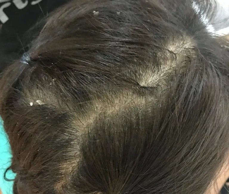 Bee Choo dandruff herbal treatment