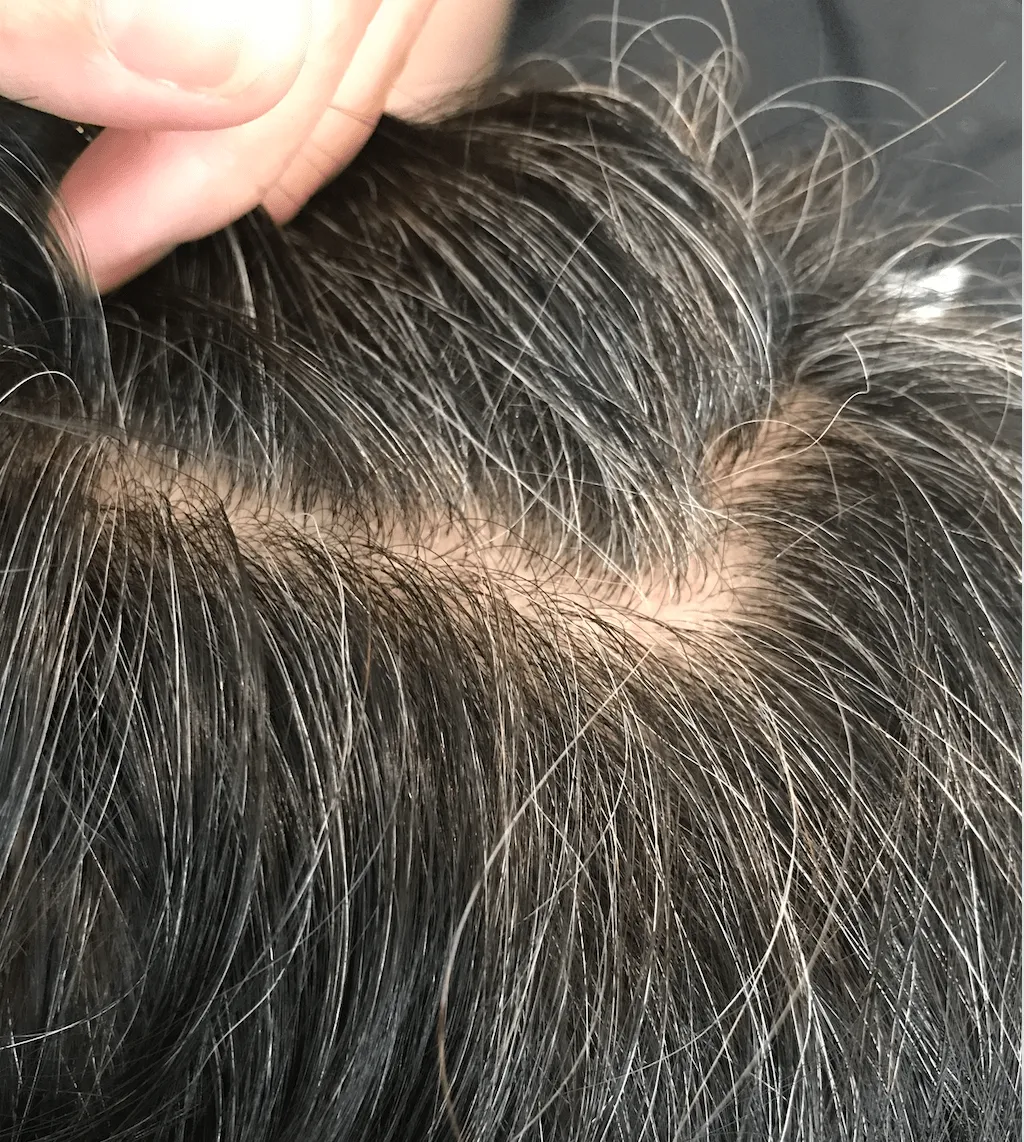 White hair before herbal treatment