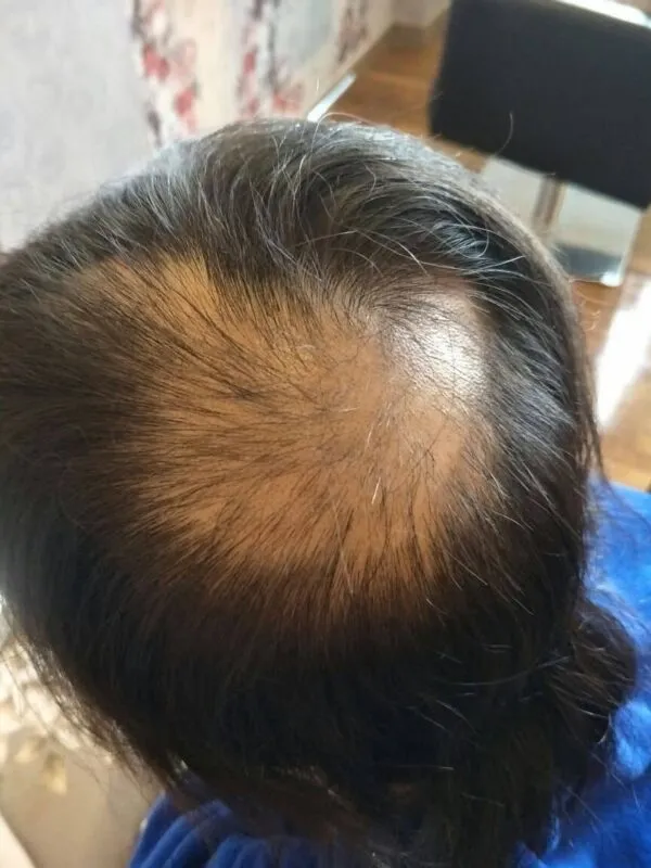 Client's scalp before Bee Choo herbal hair loss treatment