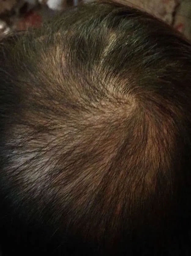 The same client's scalp part way through the course of treatment