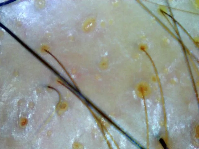 Client receiving Bee Choo herbal hair loss treatment