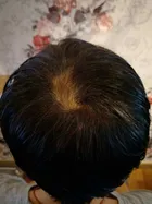 Karen's scalp progress photo, 5 January 2018