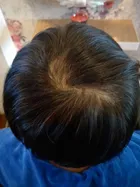 Karen's scalp progress photo, 18 January 2018