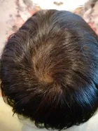 Karen's scalp progress photo, 9 February 2018