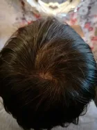 Karen's scalp progress photo, 25 February 2018