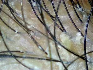 dandruff scalp hair scan