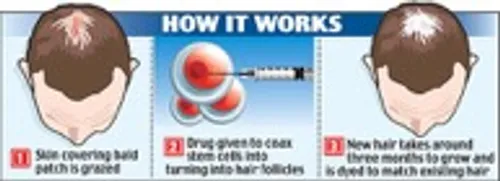 How does stem cell therapy work for hair loss?