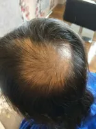 Trixie's scalp progress photo, 23 May 2017