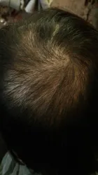 Trixie's scalp progress photo, 8 July 2017