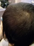 Trixie's scalp progress photo, 19 August 2017